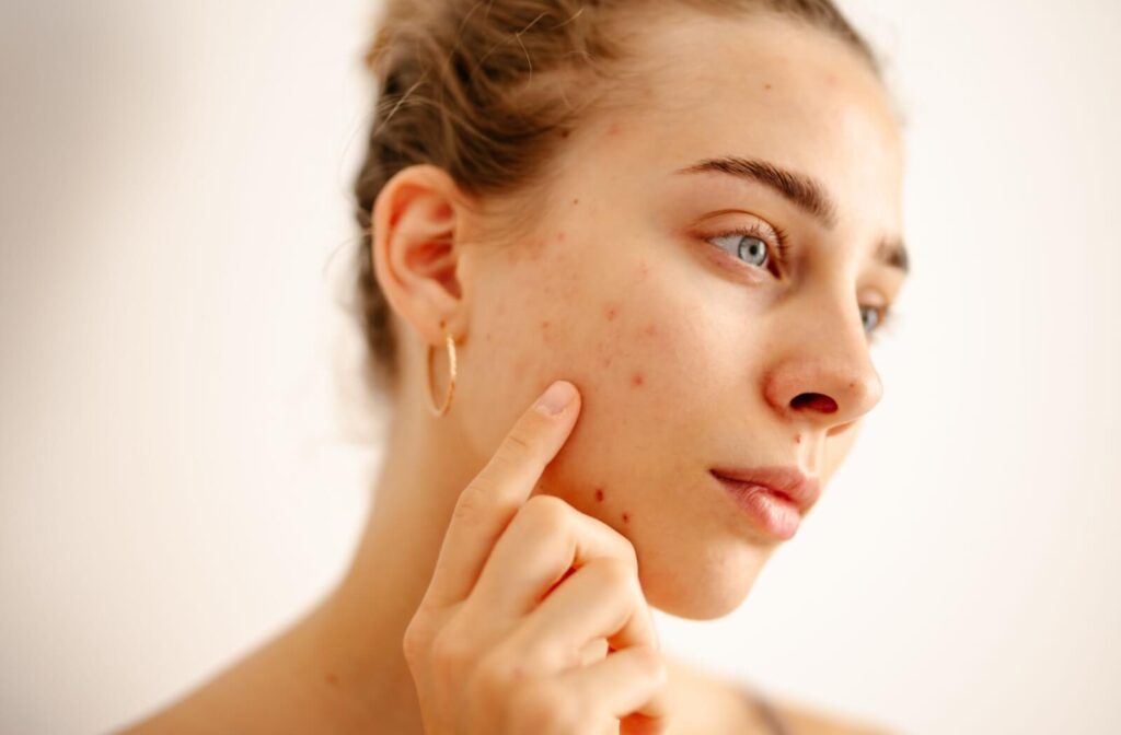 Close-up of a woman touching acne spots on her cheek while evaluating her skin before treatment.